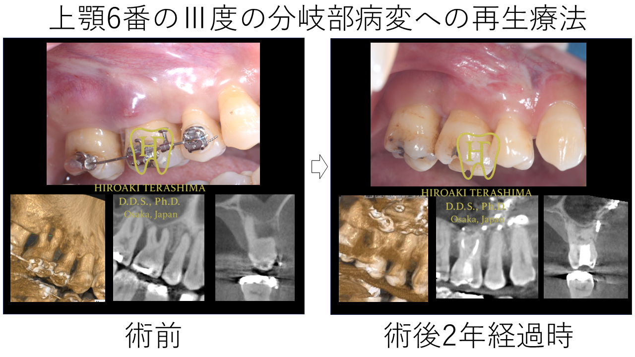 上顎6番のⅢ度分岐部病変に対する再生療法 〜リグロス＆骨補填材を用