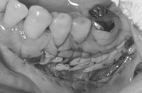 箕面市の歯医者【寺嶋歯科医院】歯肉移植による歯周形成外科処置