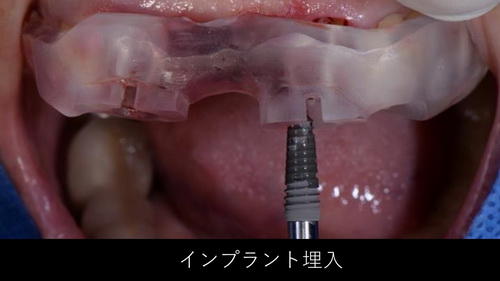 抜歯即時埋入即時荷重とは