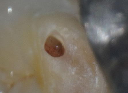 まだ神経取りますか？？？