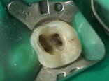 根管治療　歯内療法　歯根端切除とは？