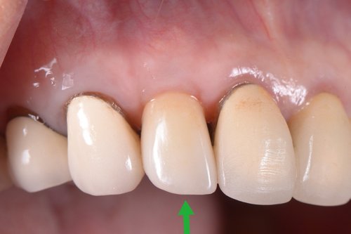 前歯のインプラント治療は簡単？？