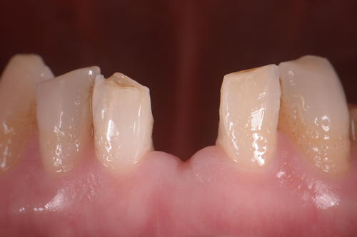 症例　-　下顎前歯部の接着性ブリッジ