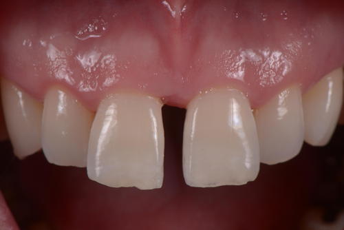 前歯のすきっぱの治療～ラミネートベニア～