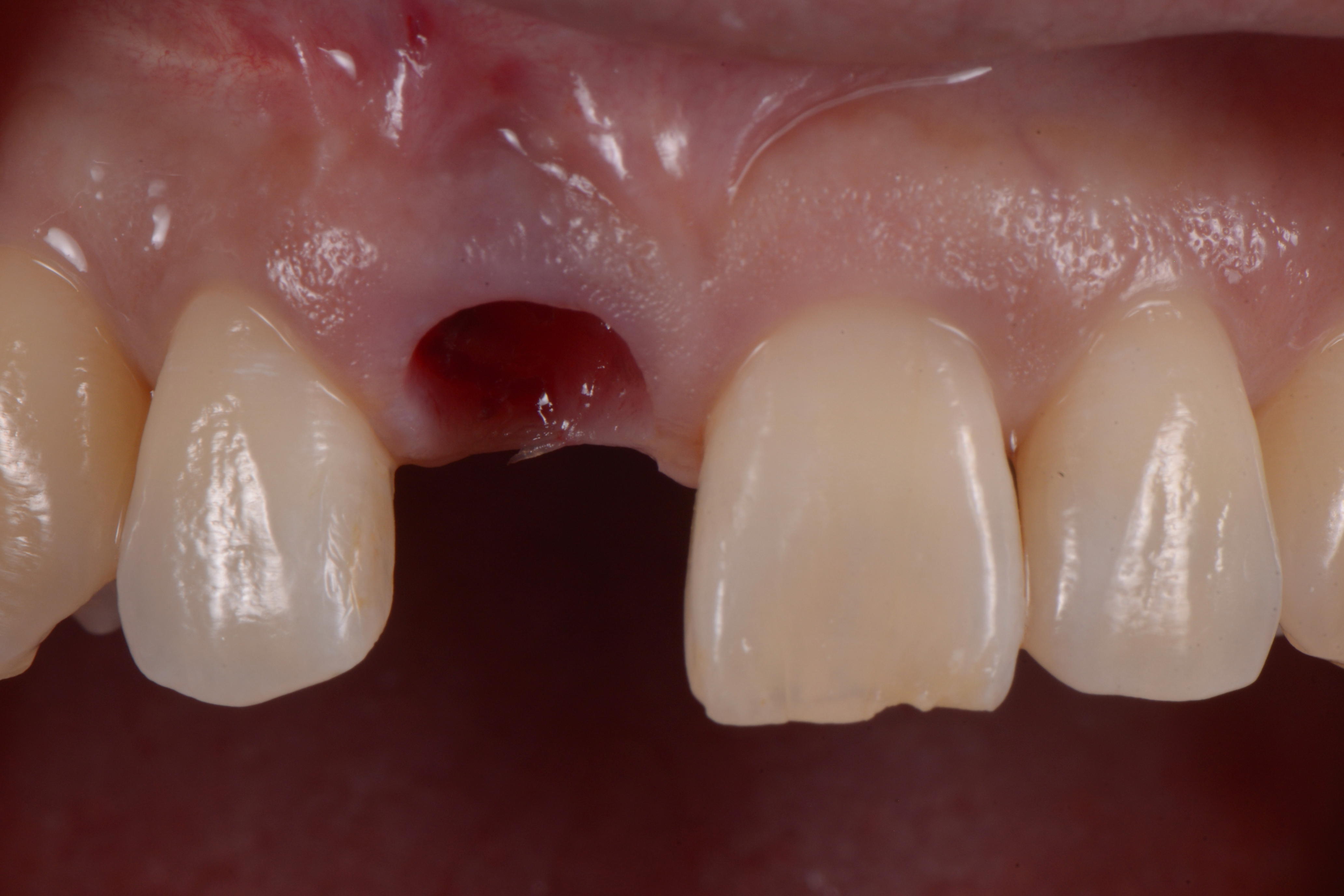 ＜症例＞前歯のインプラント～デジタル歯科を駆使した抜歯即時埋入即時荷重～