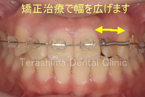 前歯のインプラントと矯正治療