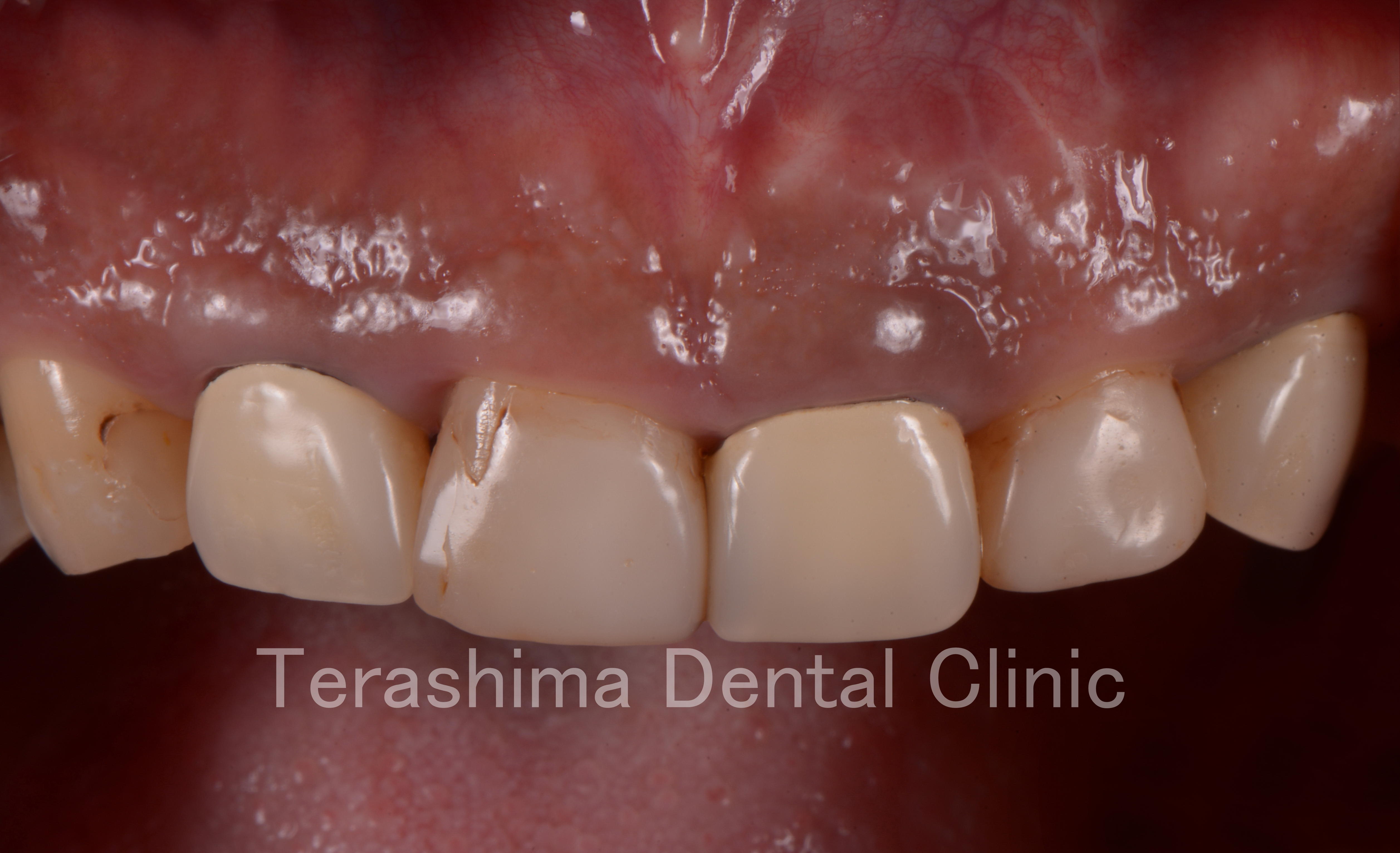 前歯部6本のラミネートべニアとオールセラミッククラウンの審美歯科の症例　