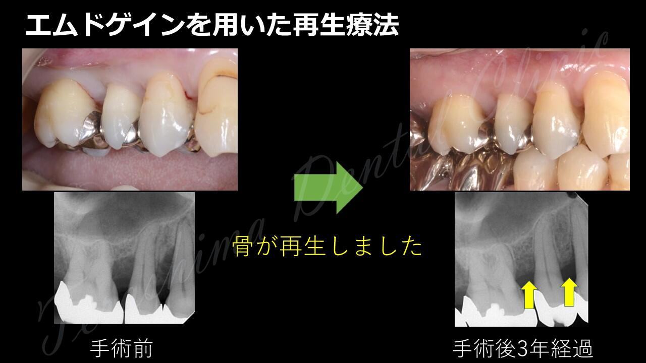 歯周組織再生療法～エムドゲインを用いた症例～