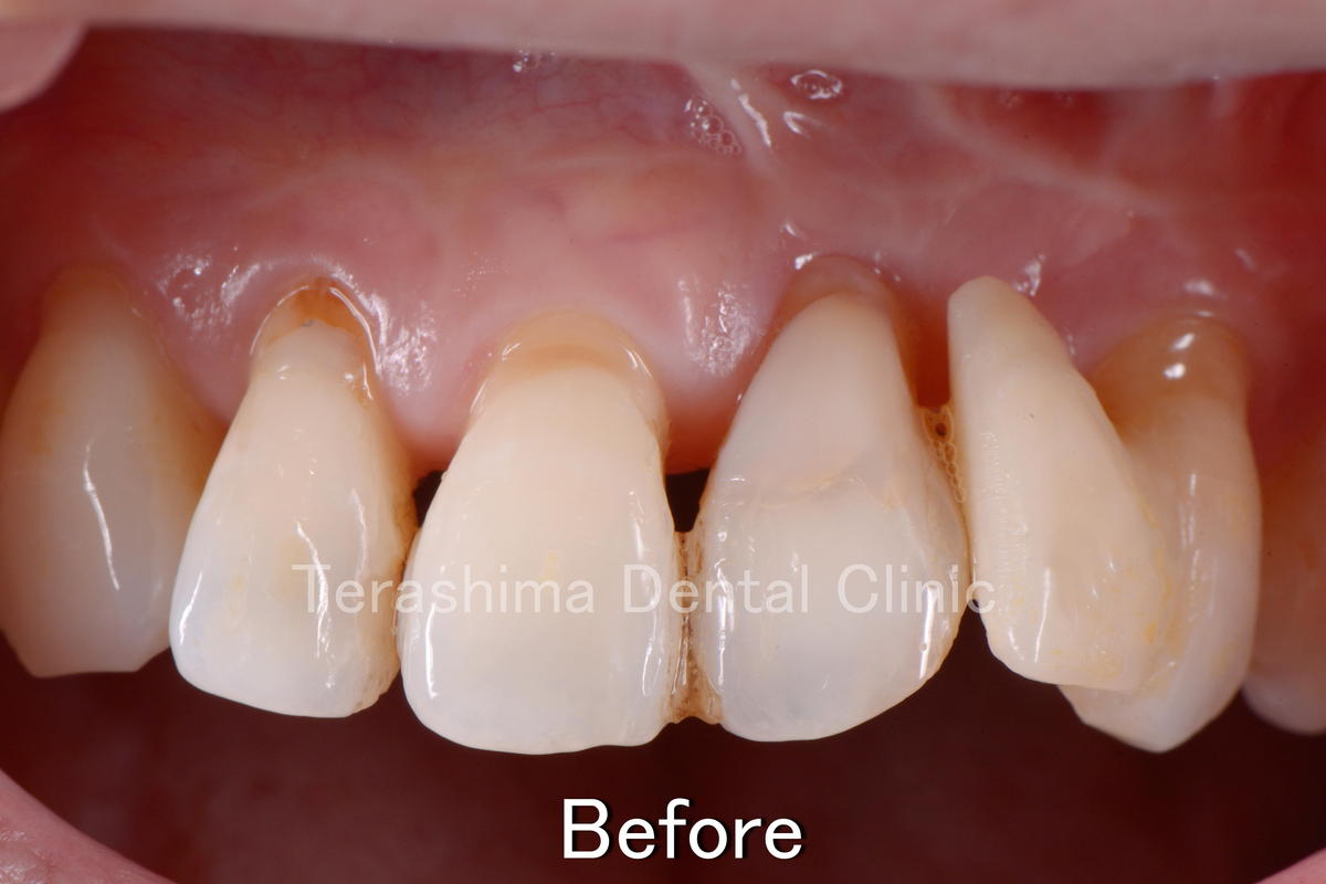 前歯のインプラント~口蓋裂患者様へのインプラント治療~ | 箕面市の 