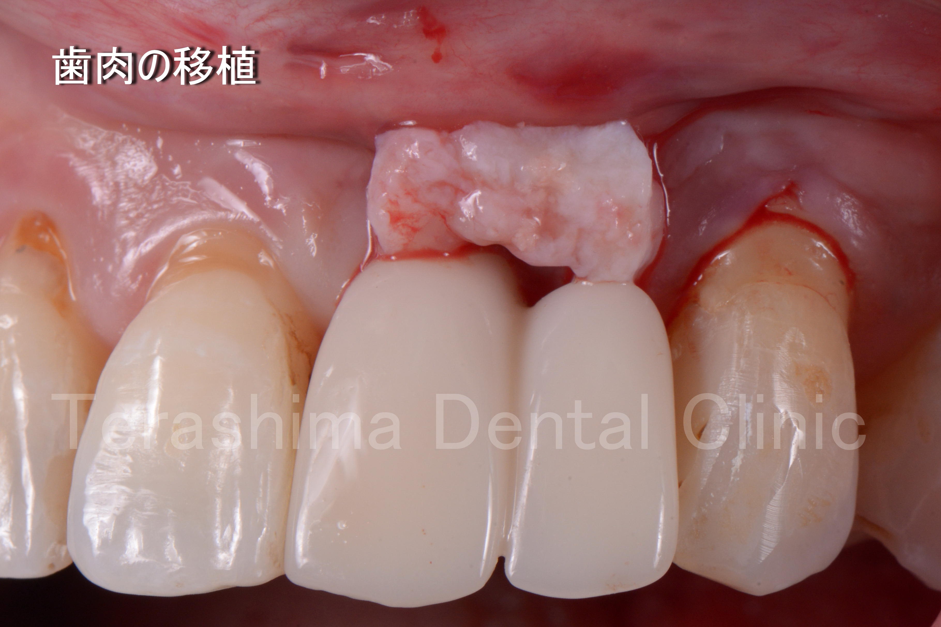 前歯のインプラント~口蓋裂患者様へのインプラント治療~