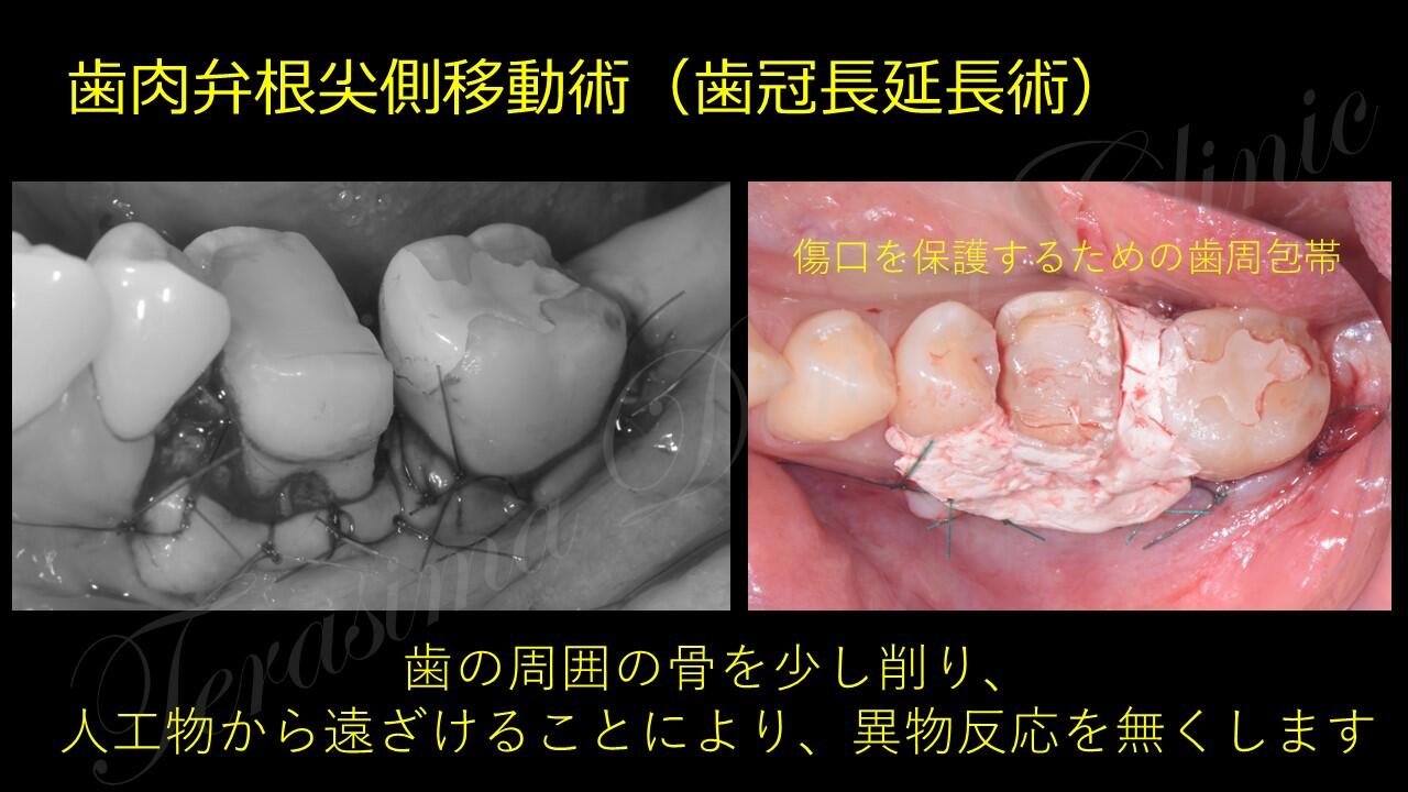 クラウンレングスニング　歯の長さを延ばす手術