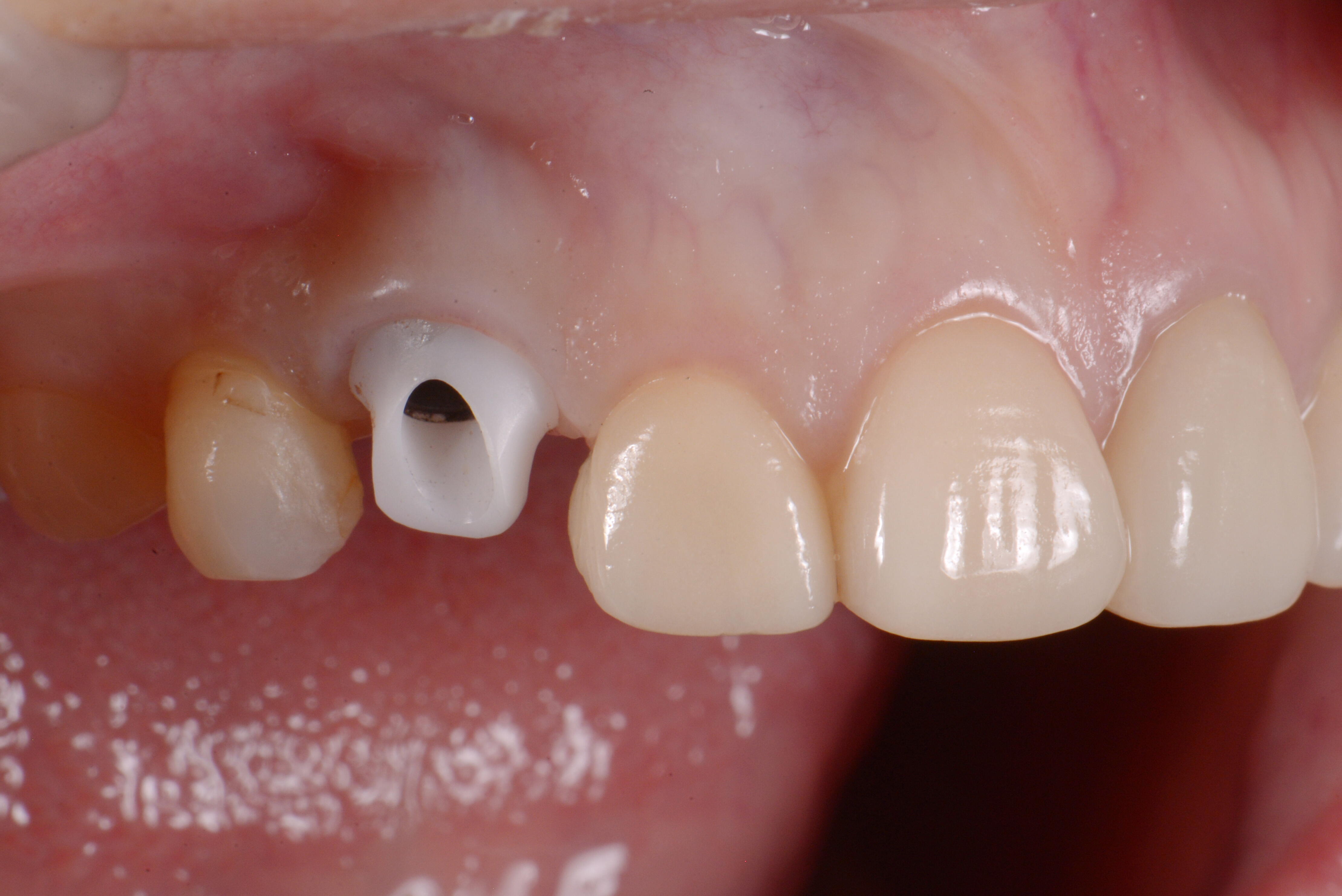 前歯のインプラント　～歯茎のラインを整えたケース～