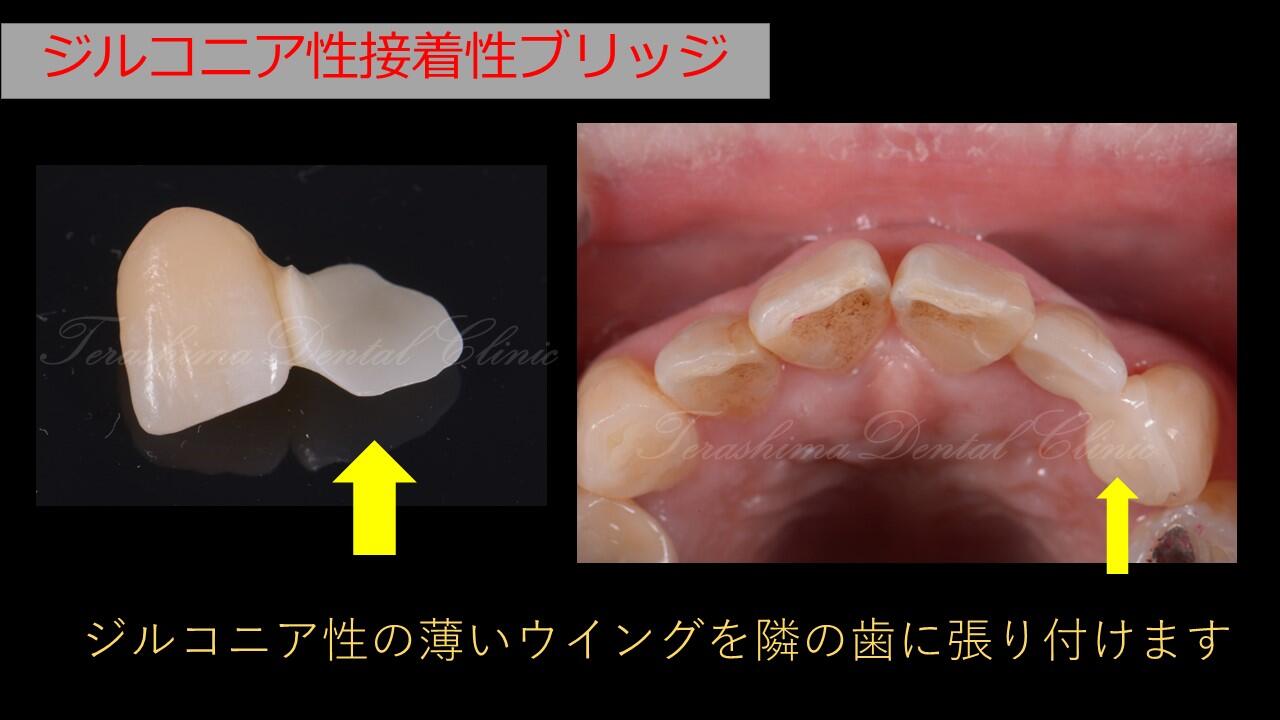前歯のジルコニア性接着性ブリッジの症例