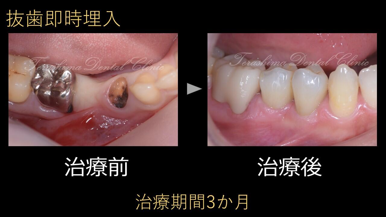 奥歯の抜歯即時埋入の症例