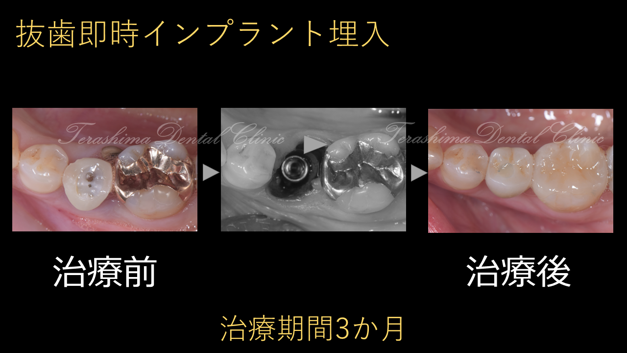 抜歯即時埋入の症例~下顎小臼歯～