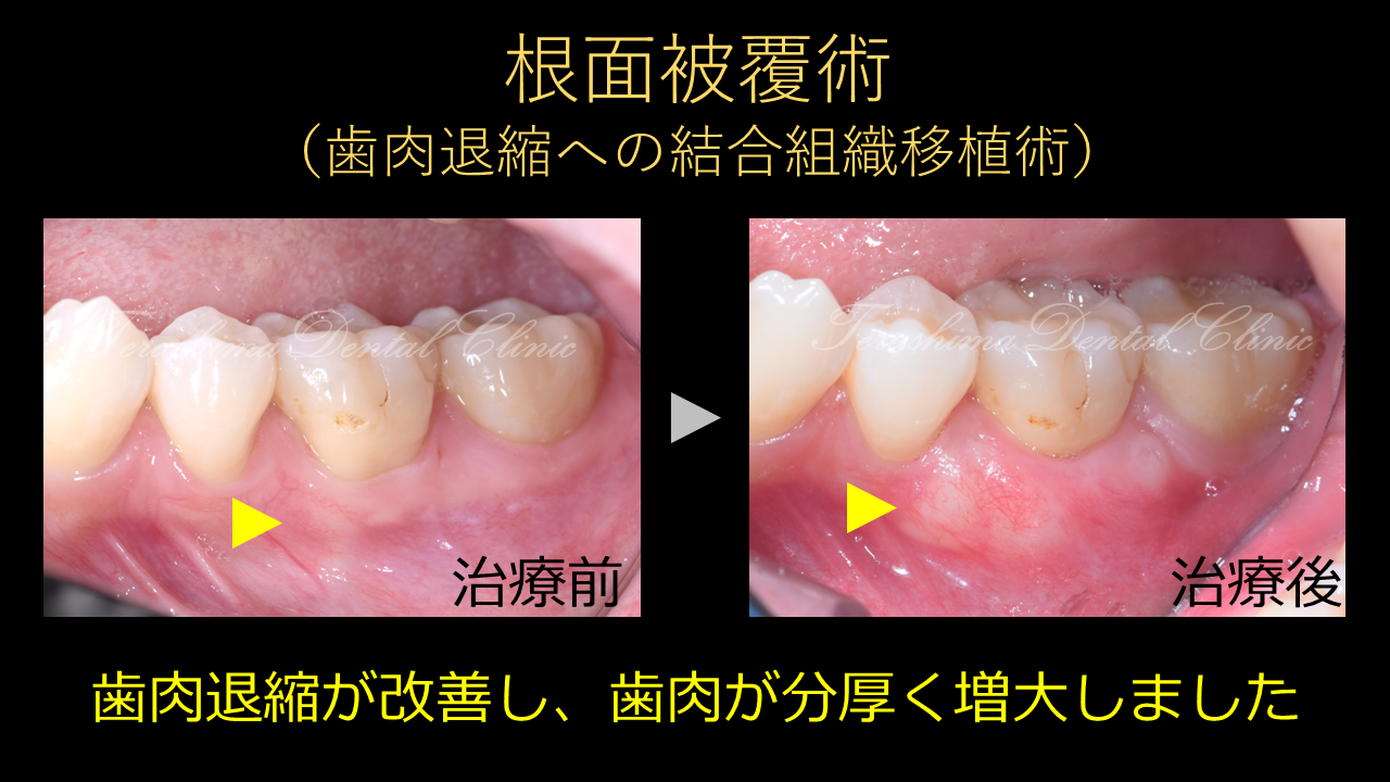 大臼歯の歯肉退縮に対する根面被覆術～結合組織移植術～