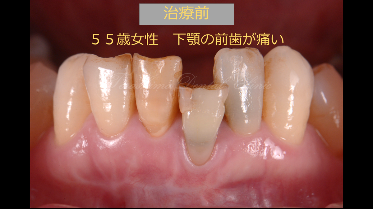 下顎前歯のインプラント～抜歯即時埋入＆即時仮歯、歯が無い時期は 