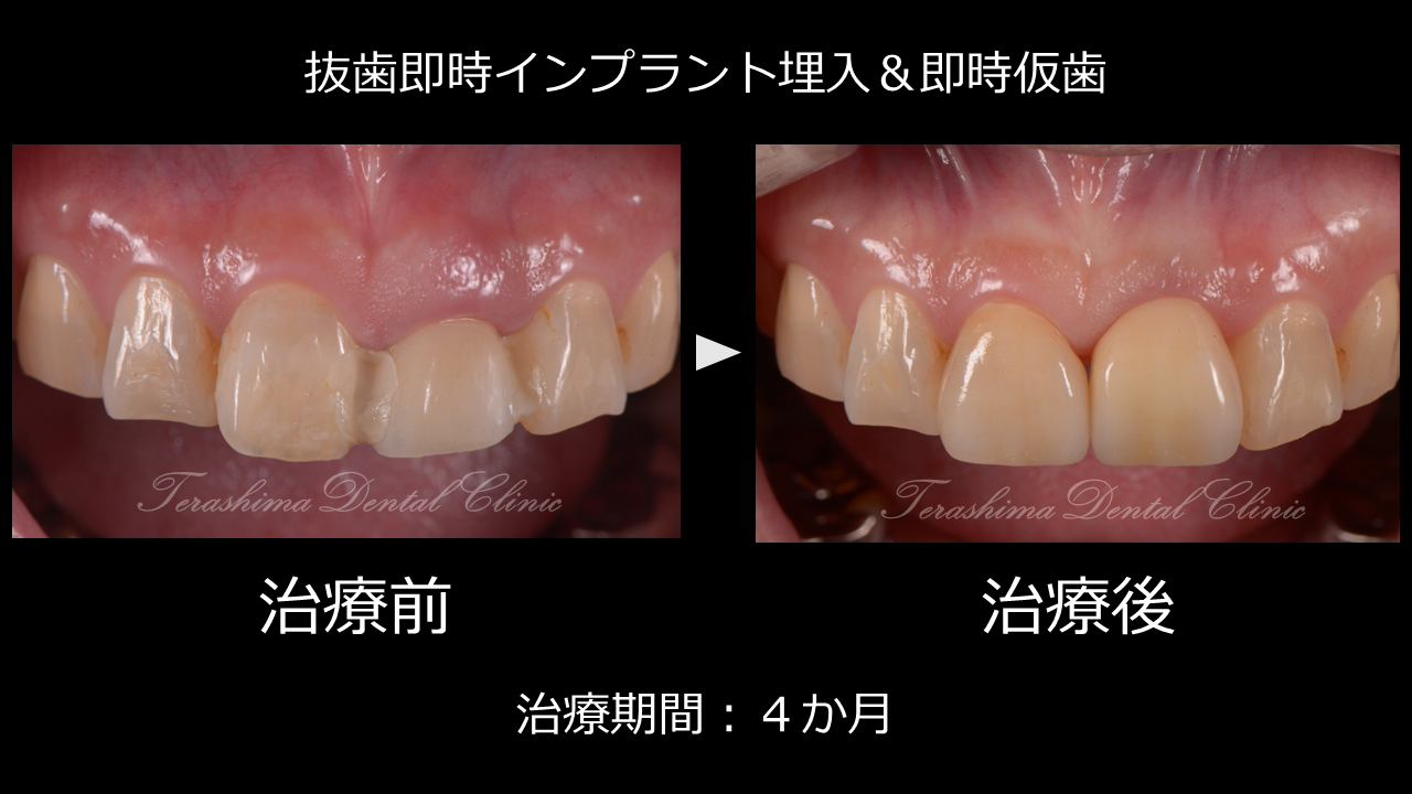 前歯のインプラント～抜歯即時埋入即時仮歯とラミネートべニアの症例～