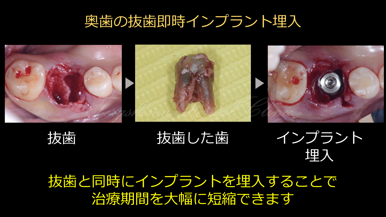強い感染がある下顎大臼歯の抜歯即時インプラント埋入　
