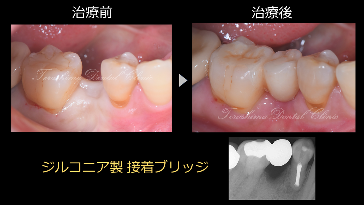 奥歯の接着ブリッジ～ジルコニアブリッジ～ | 箕面市の歯医者【寺嶋