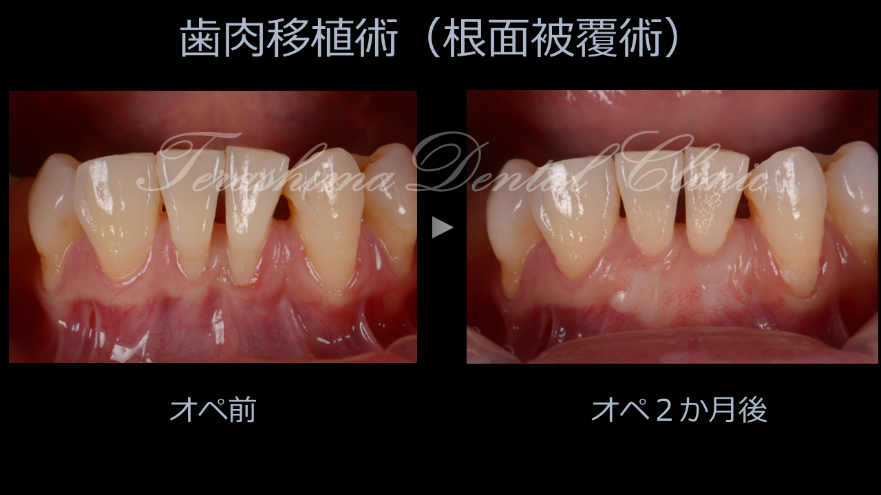 下顎前歯部の歯肉退縮への歯肉移植術（根面被覆術）