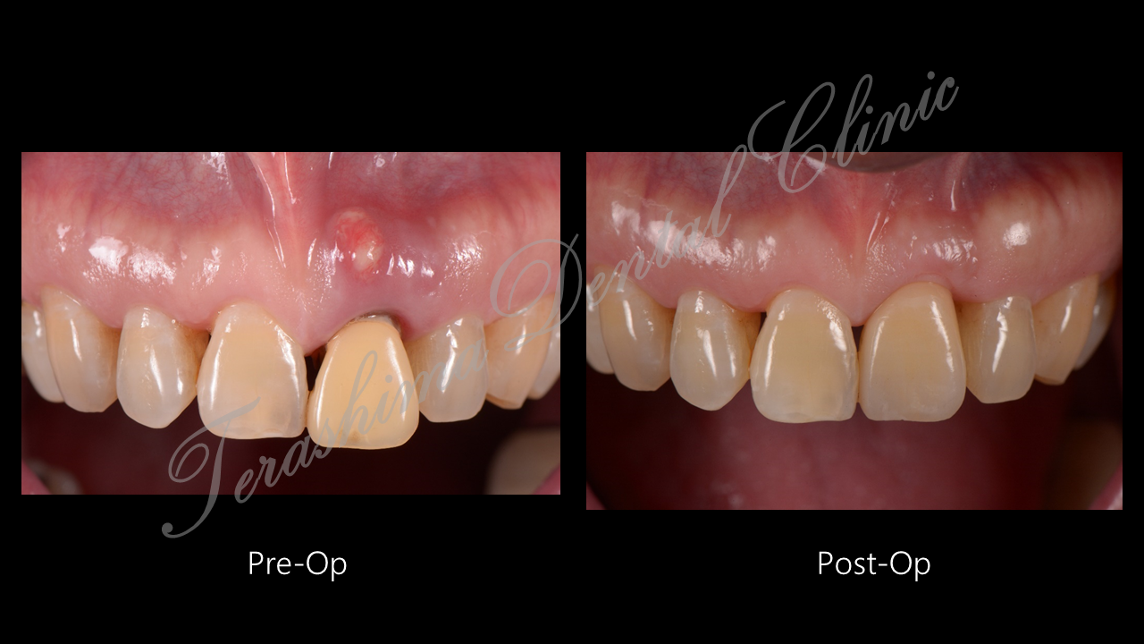 前歯のインプラント～抜歯即時埋入と歯肉の移植、そしてトラブルリカバリー症例～