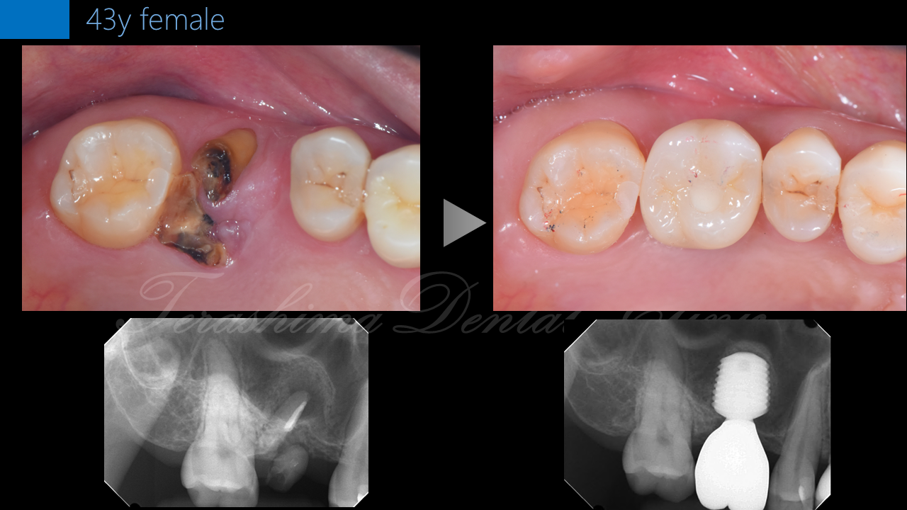 上顎奥歯の抜歯即時埋入～治療期間はたった2か月半～