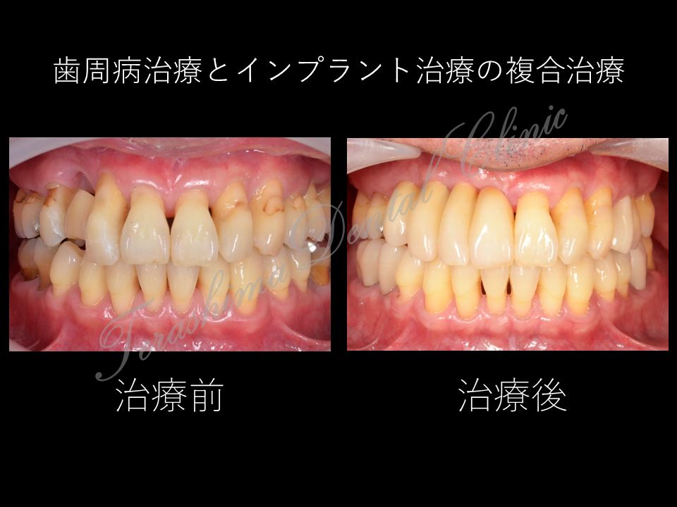 歯周病治療とインプラント治療の総合的治療の１症例