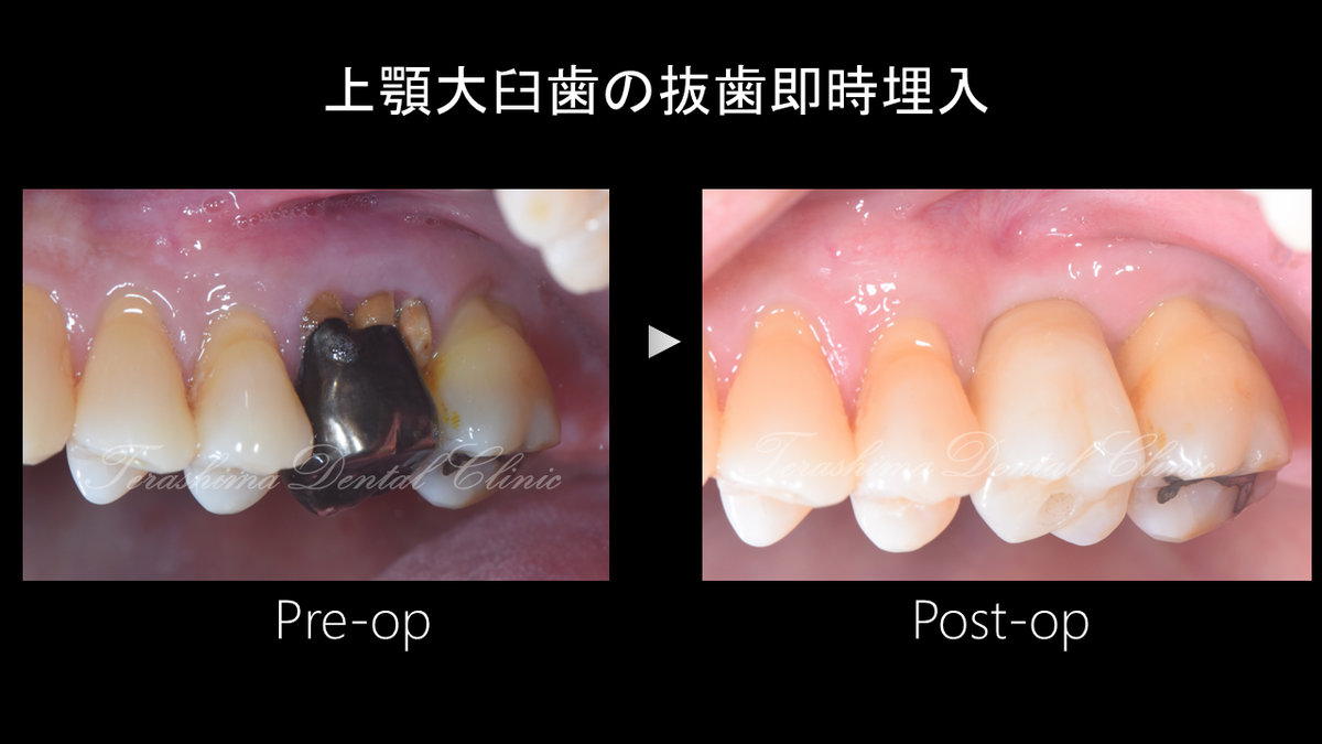 上顎奥歯の抜歯即時インプラント埋入～治療期間3か月～ | 箕面市の 