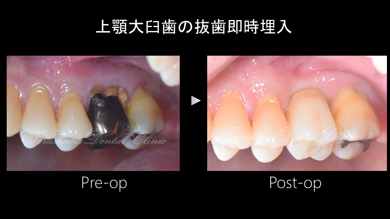 上顎奥歯の抜歯即時インプラント埋入～治療期間3か月～