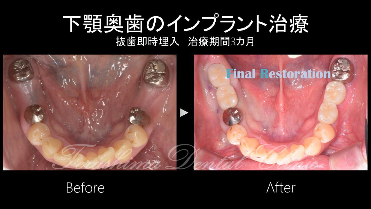 奥歯のインプラント~抜歯即時埋入　治療期間3カ月~