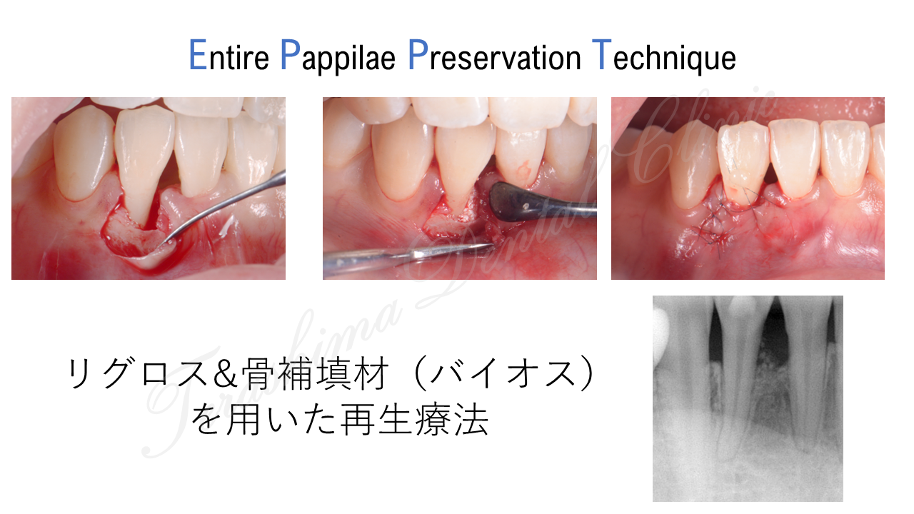 歯周病の再生治療の症例～Entire Pappilae Preservation Technique～
