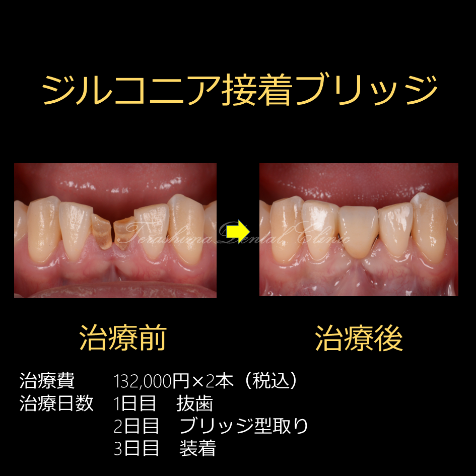 下顎前歯部の接着ブリッジの症例～インプラントとどっちが良いか？～