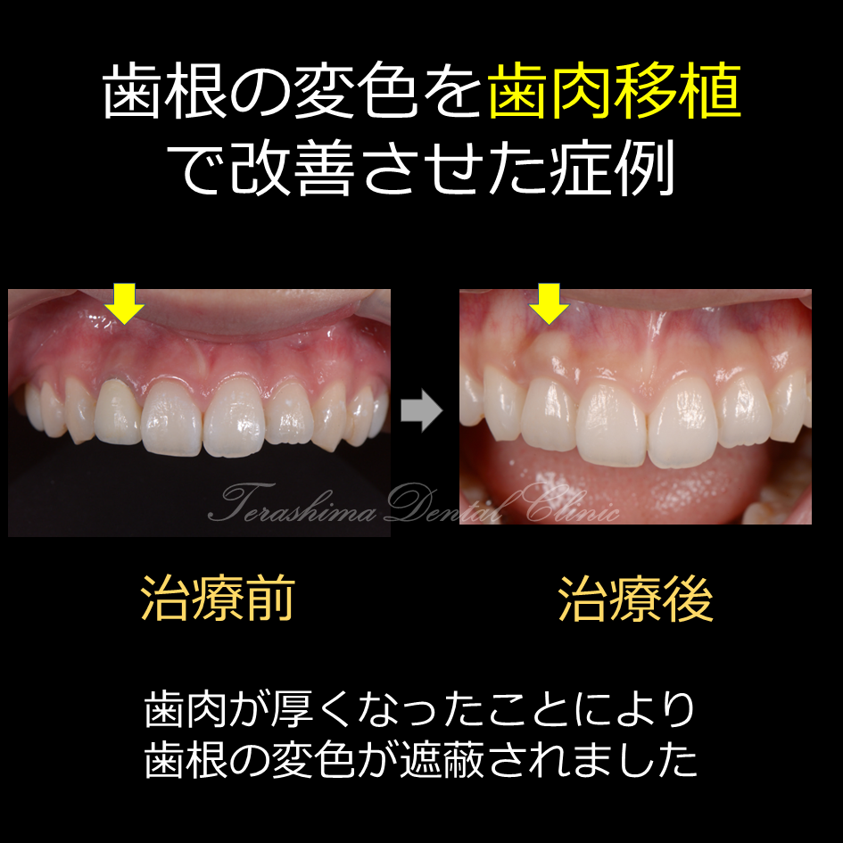 ＜歯科医師向け＞結合組織移植を用いて変色歯根を遮蔽するテクニック