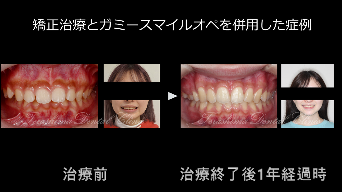 矯正治療とオペを併用した総合治療～20歳女性～ | 箕面市の歯医者
