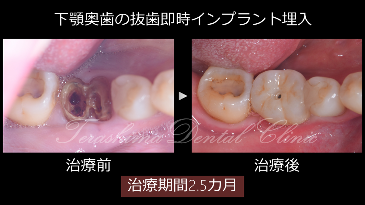 シングル・トゥースインプラント : 前歯部および臼歯部抜歯窩に対する低侵襲アプロ シングル・トゥースインプラント: 前歯部および臼歯部抜歯窩に対する低
