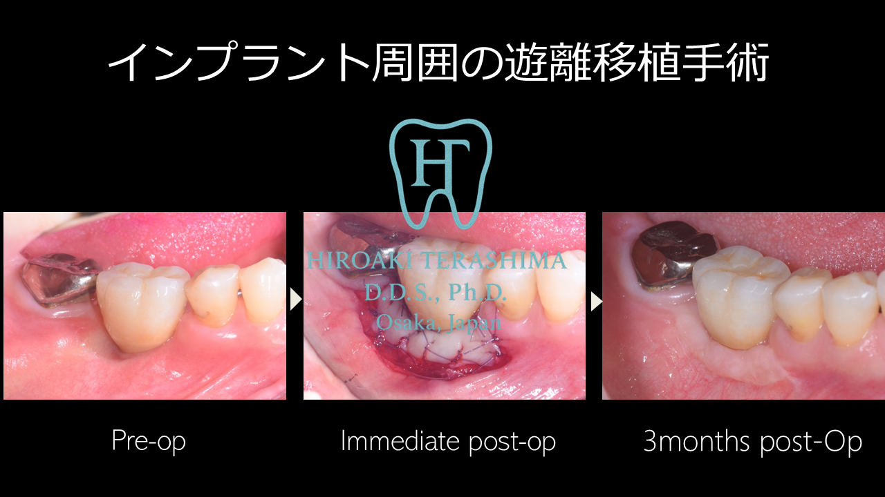 インプラント周囲の角化歯肉移植症例  ～遊離歯肉移植術（Free Gingival Graft）～