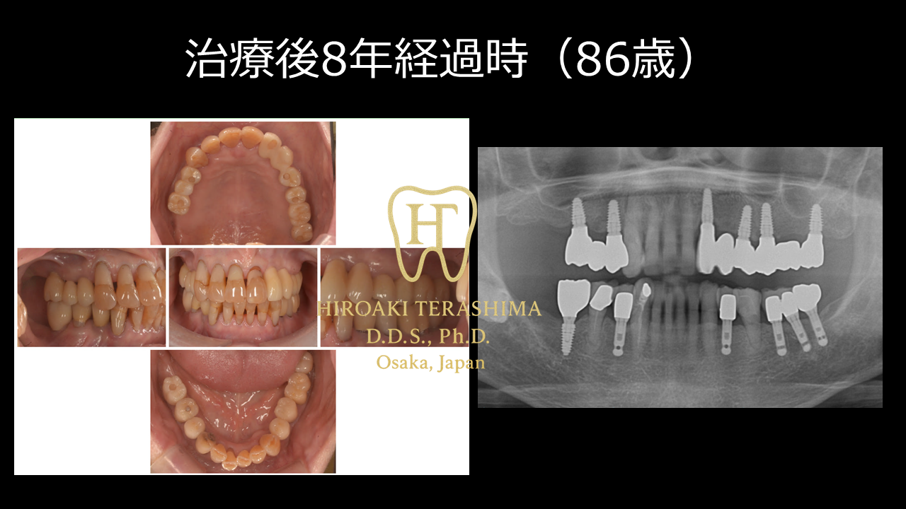 高齢でもインプラント治療はできる？ 78歳で治療を受けた患者様の8年経過