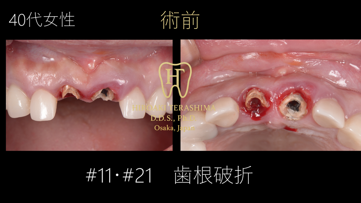 前歯インプラント治療症例 ～ルートメンブレンテクニックで自然な