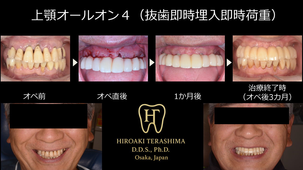 【上顎が全てグラグラでも当日で噛める】抜歯即時埋入×即時荷重オールオン4で3カ月完了｜大阪・箕面のインプラント症例