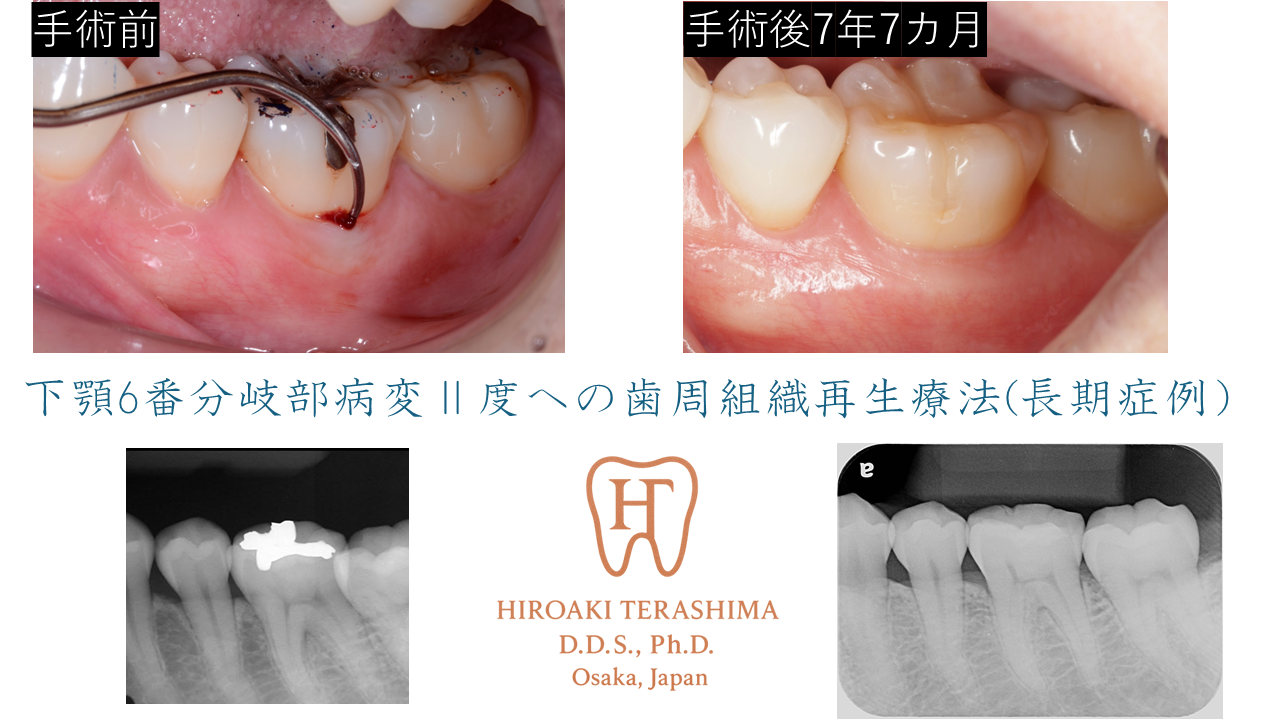 Ⅱ度分岐部病変に対する再生療法で長期安定を得た症例（左下6番・7年7カ月経過）