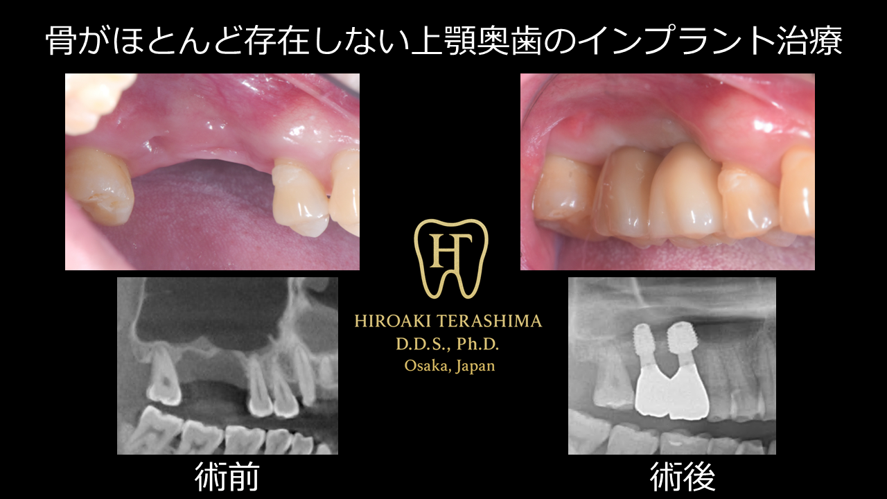 骨がほとんどない上顎奥歯に対するインプラント治療 ― 既存骨1mm以下からのグラフトレスサイナスリフト症例 ―