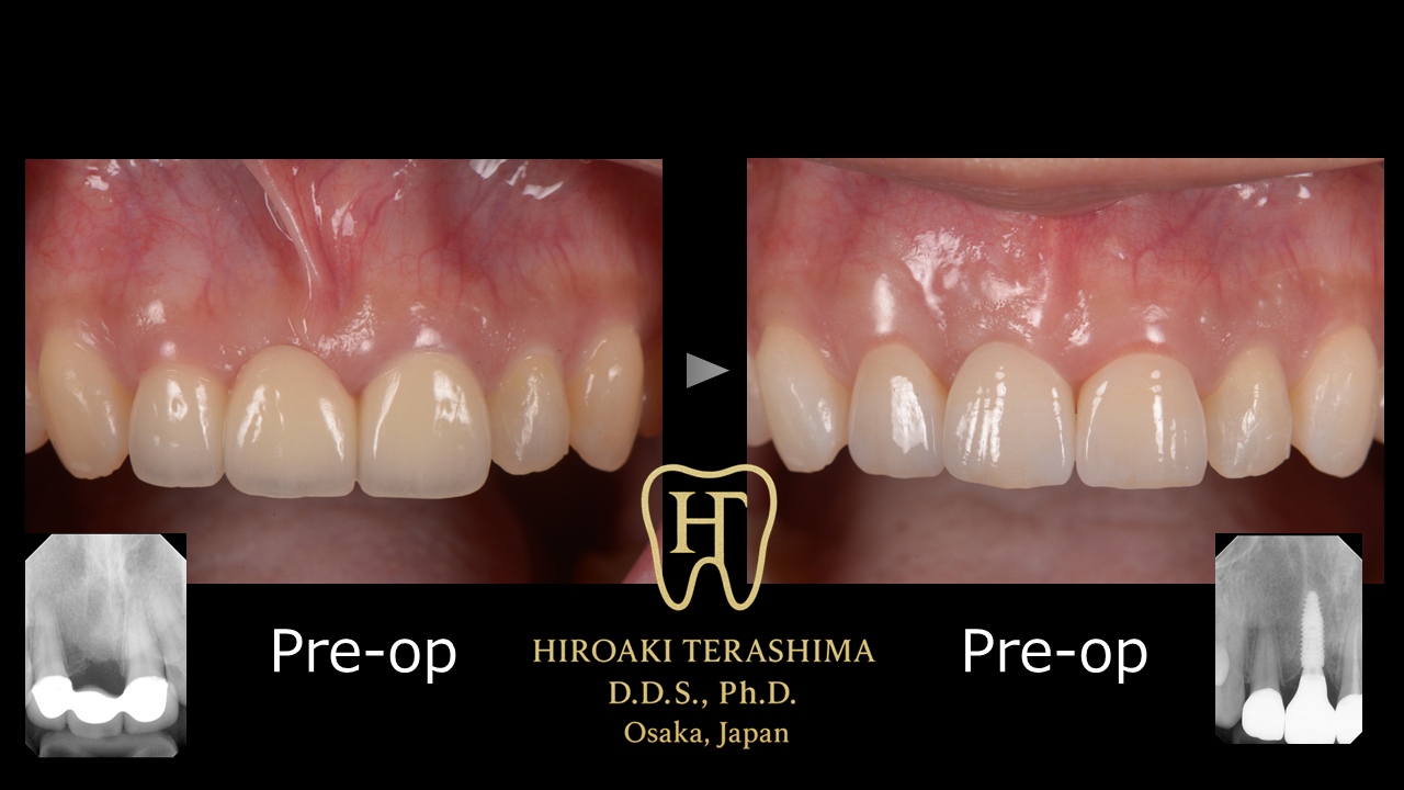 前歯ブリッジの痛みを改善し、インプラントで審美回復　～骨が狭い症例に対する同時骨造成（GBR）＋歯肉移植（CTG）併用インプラント治療