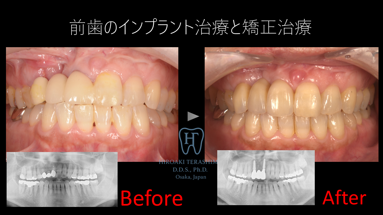 前歯のインプラント治療と矯正治療を併用した症例～口蓋裂患者様～