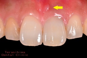 前歯部のセラミックインプラント治療・治療前