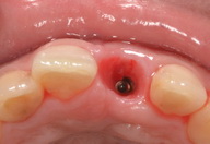 前歯部のセラミックインプラント治療・治療途中
