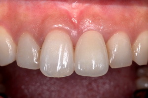 前歯部のセラミックインプラント治療・治療後