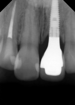 前歯部のセラミックインプラント治療・治療後