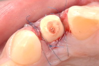 歯肉弁根尖側移動術における縫合（6-0縫合糸）