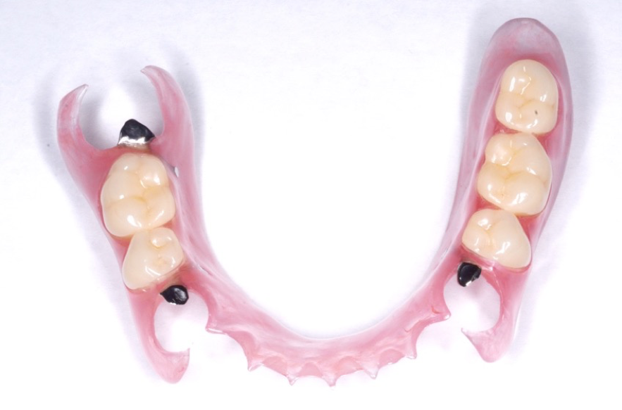 自費の入れ歯の素材は、金属やシリコン